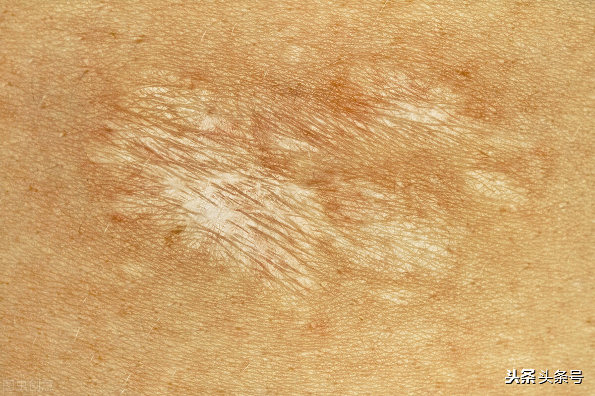 疤痕体质怎么改善调理吃什么,疤痕体质怎么改善变瘦