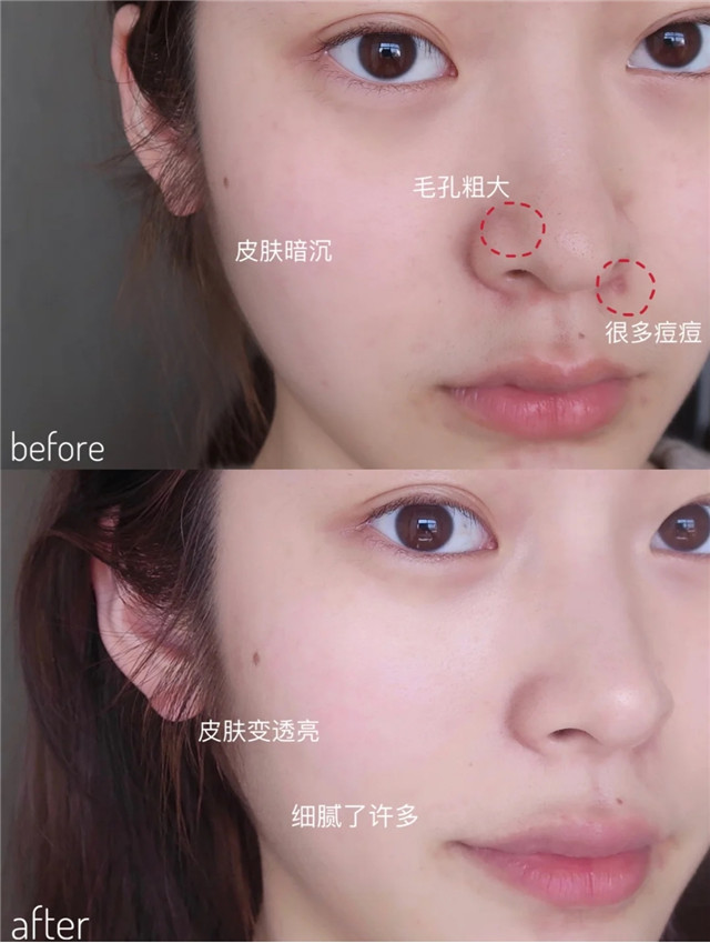 想要皮肤皱纹少这三个动作少不了,30岁出现了皱纹松弛可逆吗