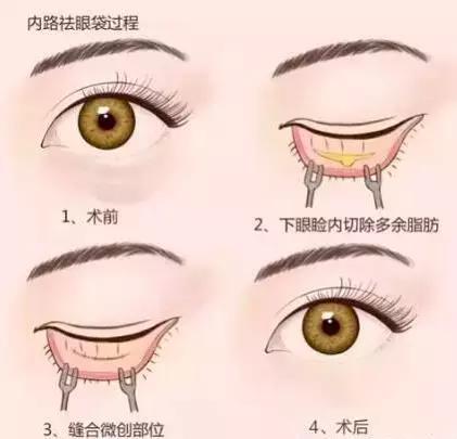 去眼袋15年后有细纹怎么办,祛眼袋之后会不会看着很平