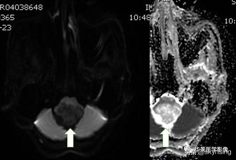 椎体侵袭性血管瘤mri影像学表现,中年妇女脑部血管海绵体瘤的症状