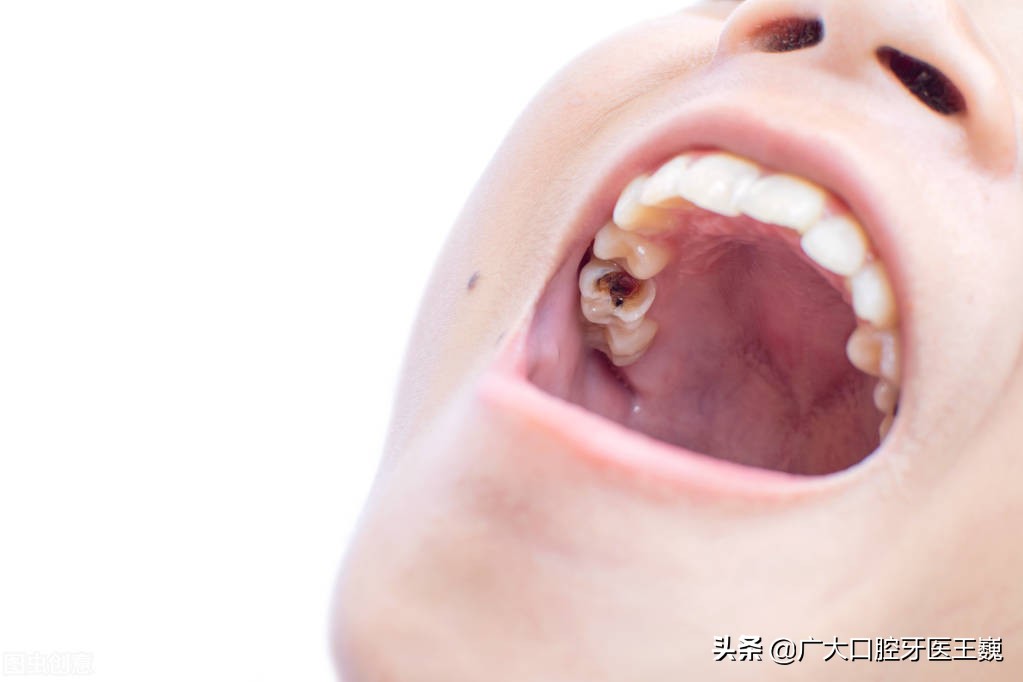 牙齿一半裂了可以只拔掉一半吗,牙齿烂了只剩一点了怎么拔