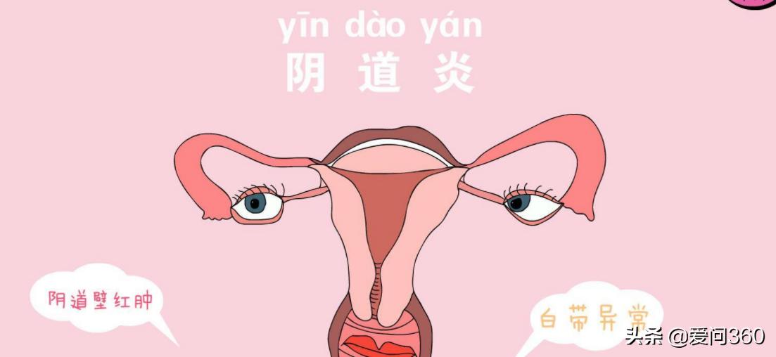 妇科炎症要注意哪些呢,妇科炎症需要注意哪些事项