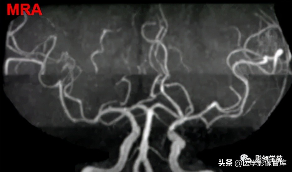 鞍区肿瘤做什么检查得出来,鞍区肿瘤的影像学鉴别