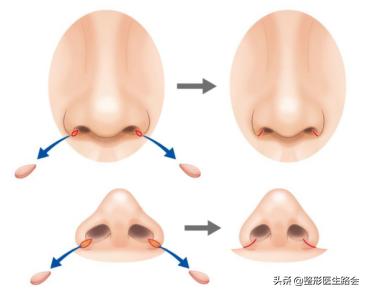 鼻翼缩小外切好吗,鼻翼缩小外切还是内切效果好