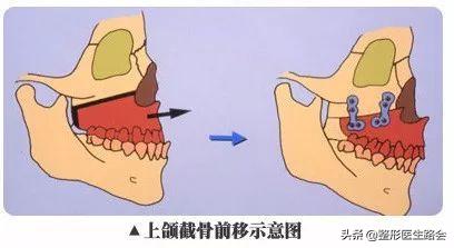 面中部凹陷下巴微翘,朱元璋式下巴怎么矫正