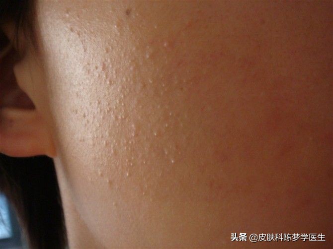 青春痘治疗最佳中成药,青春痘最好的治疗方案