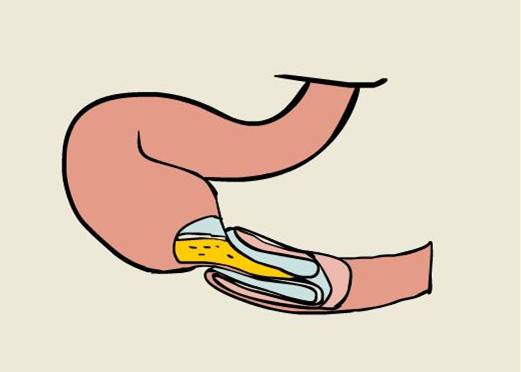 5岁小孩肚子一阵一阵疼和吐,6岁孩子肚子疼肠套叠怎么回事