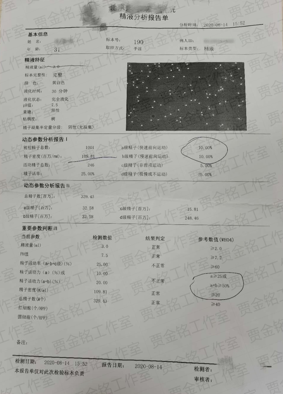 弱精子症患者备孕两个月的治疗精液检查，很开心回家可以要宝宝啦