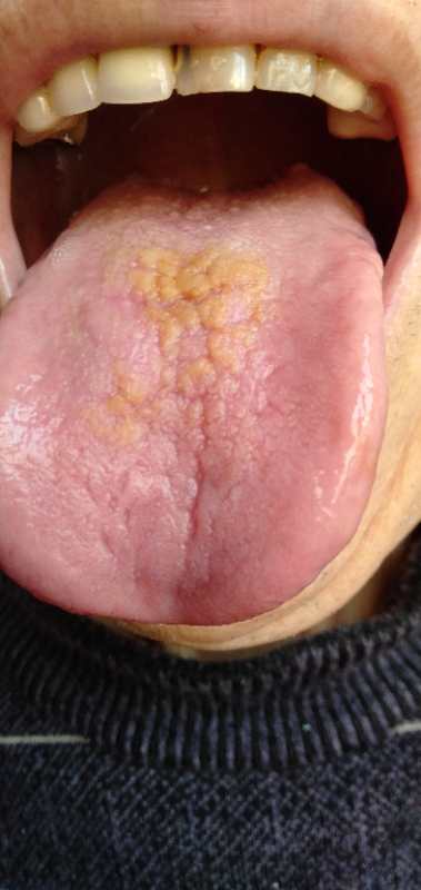 中西医结合治疗原因不明肠梗阻、腹水转氨酶明显升高病案一例！