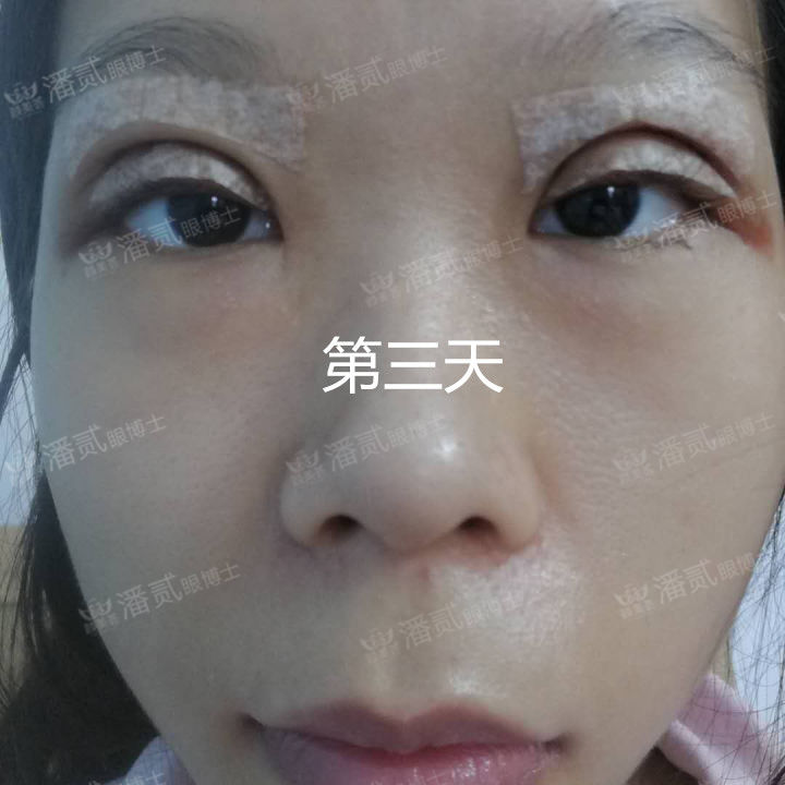 原来双眼皮不好看有必要继续割吗,割双眼皮是不是越修复越难看