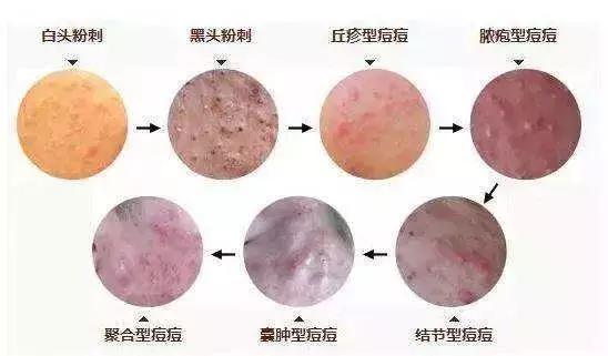 为了祛痘,小伙买10条活蚂蟥放脸上!结果悲剧了……