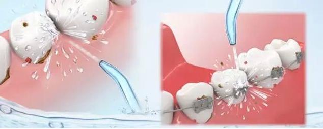 口臭原因和治疗方法刷牙容易出血,早上刷牙出血是什么原因