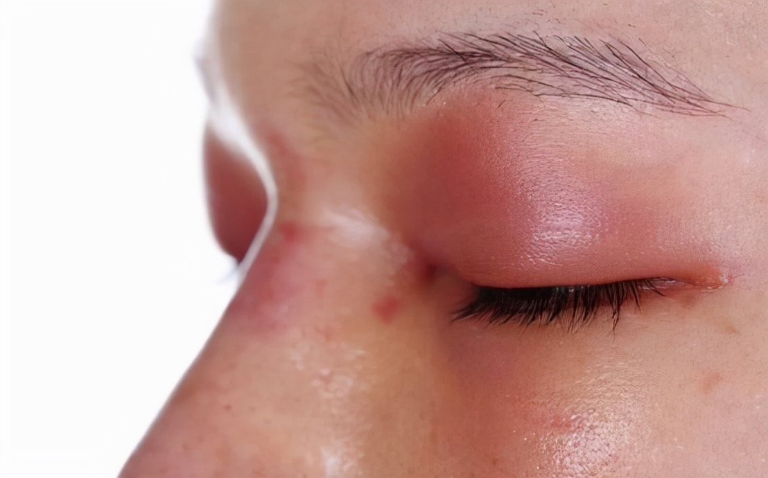 早上起来眼睛浮肿是肾不好吗,肾脏出问题导致眼睛水肿