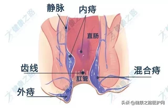 医生说痔疮不是急症是什么意思,医生说痔疮发炎