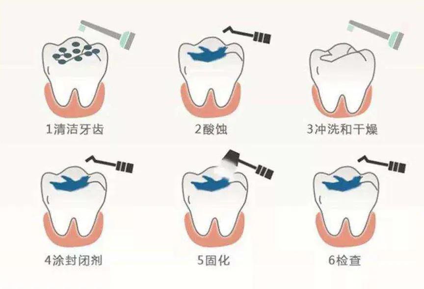 窝沟封闭预防儿童蛀牙的好方法,儿童窝沟封闭预防龋齿有什么危险