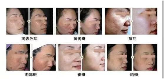 今天治疗,明天上班,激光中的“法拉利”超皮秒