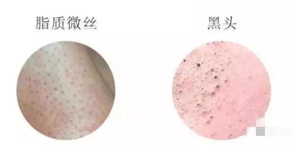 鼻子上的黑头越来越多怎么办,脸上黑头越来越多