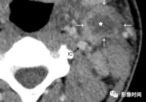 双侧颈动脉鞘间隙多发小淋巴结影,双侧颈动脉间隙多软组织密度结节