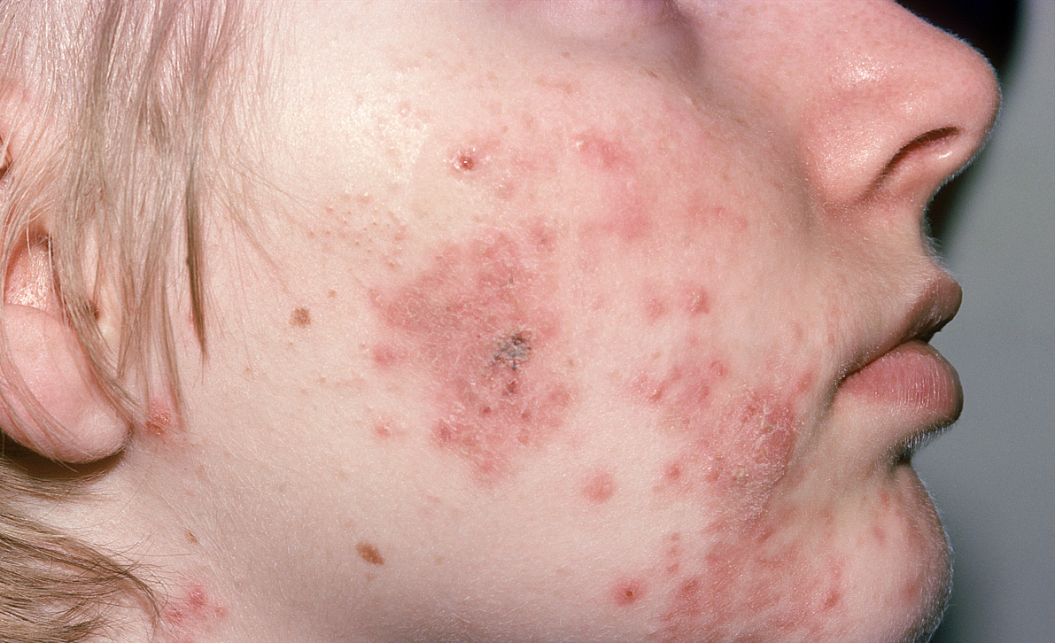 治疗痘痘到哪个医院好啊,怎么治疗痘痘最经典有效