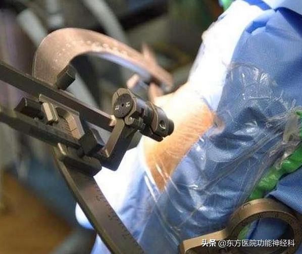 抽动秽语症手术治疗成年人,抽动秽语综合征治疗的研究