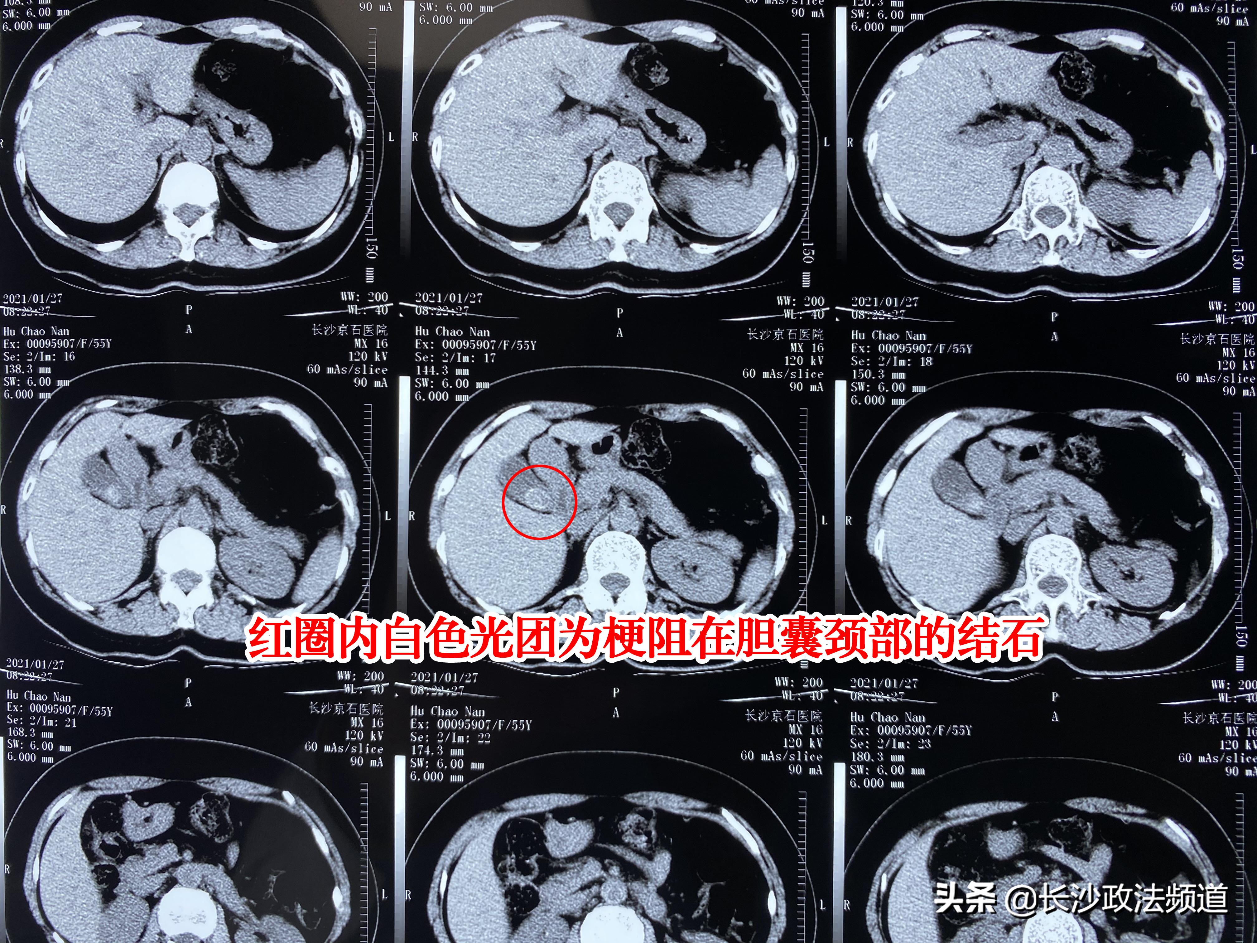 女子反复背痛,女子反复背痛肩酸