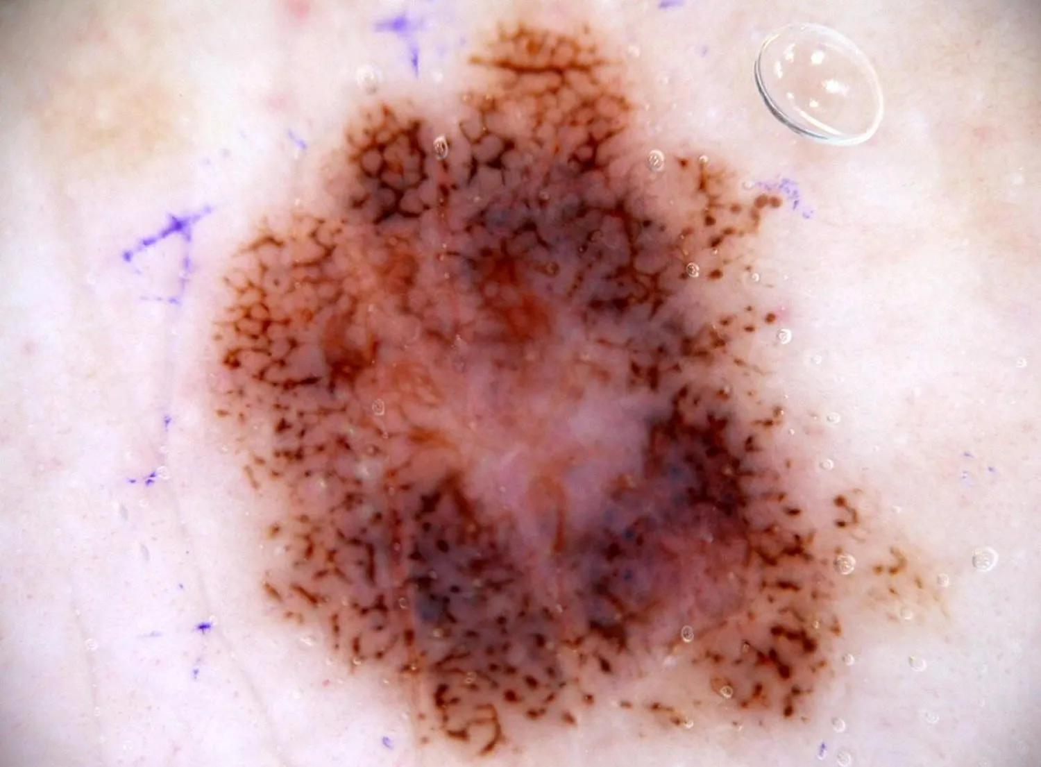 痣真的有那么大的癌变几率吗,痣会癌变真的很可怕吗