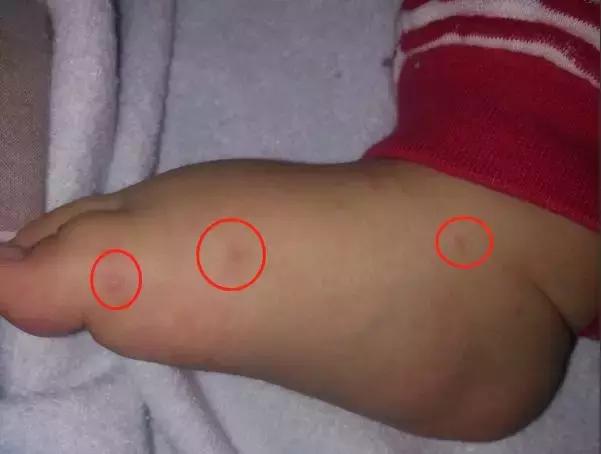 冬季手足口病症状,关于手足口病高发期的温馨提示