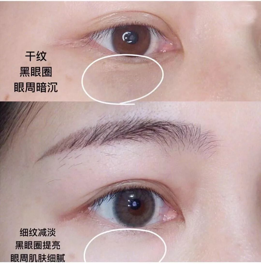 关晓彤有没有黑眼圈,关晓彤黑眼圈困扰