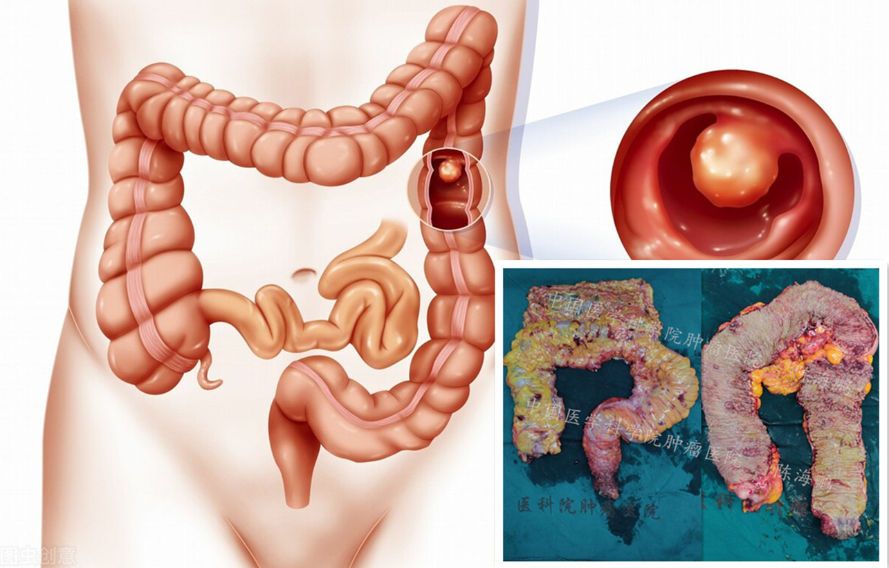肠道切息肉需要禁食几天,肠道密密麻麻的息肉严重吗