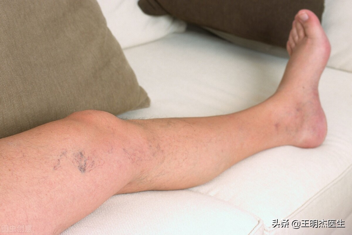 下肢静脉曲张复发原因和治疗方法,下肢静脉曲张复发怎么办