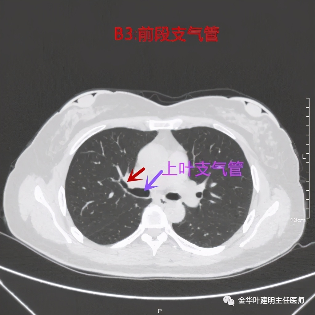 左肺上叶在ct影像上怎么看,平扫ct可以看出肺肿瘤的变化吗