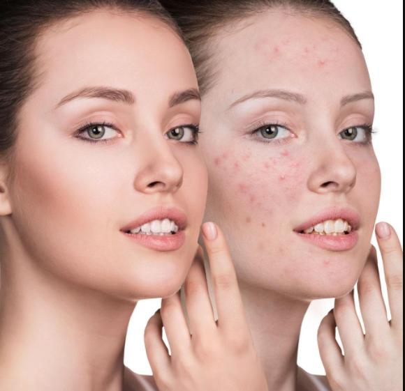 痘拜拜祛痘效果怎么样,痘痘最佳治疗方法祛痘印