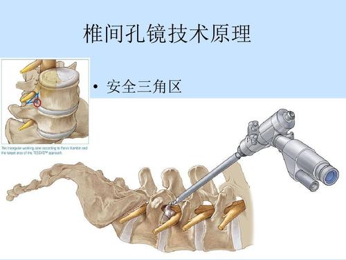 10分钟治疗椎间盘突出显奇效,椎间盘突出症保健图解