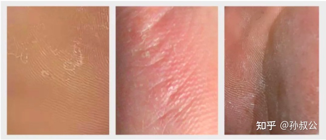 脚气脚臭脚痒的治疗方法小妙招,有脚臭脚痒裂口的脚气症状怎么治