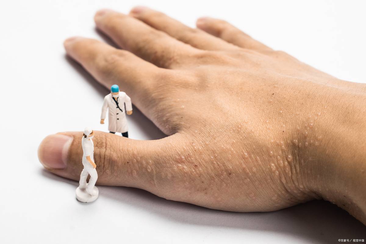 湿疹痒如何忍住不挠,脚湿疹痒挠不愈合