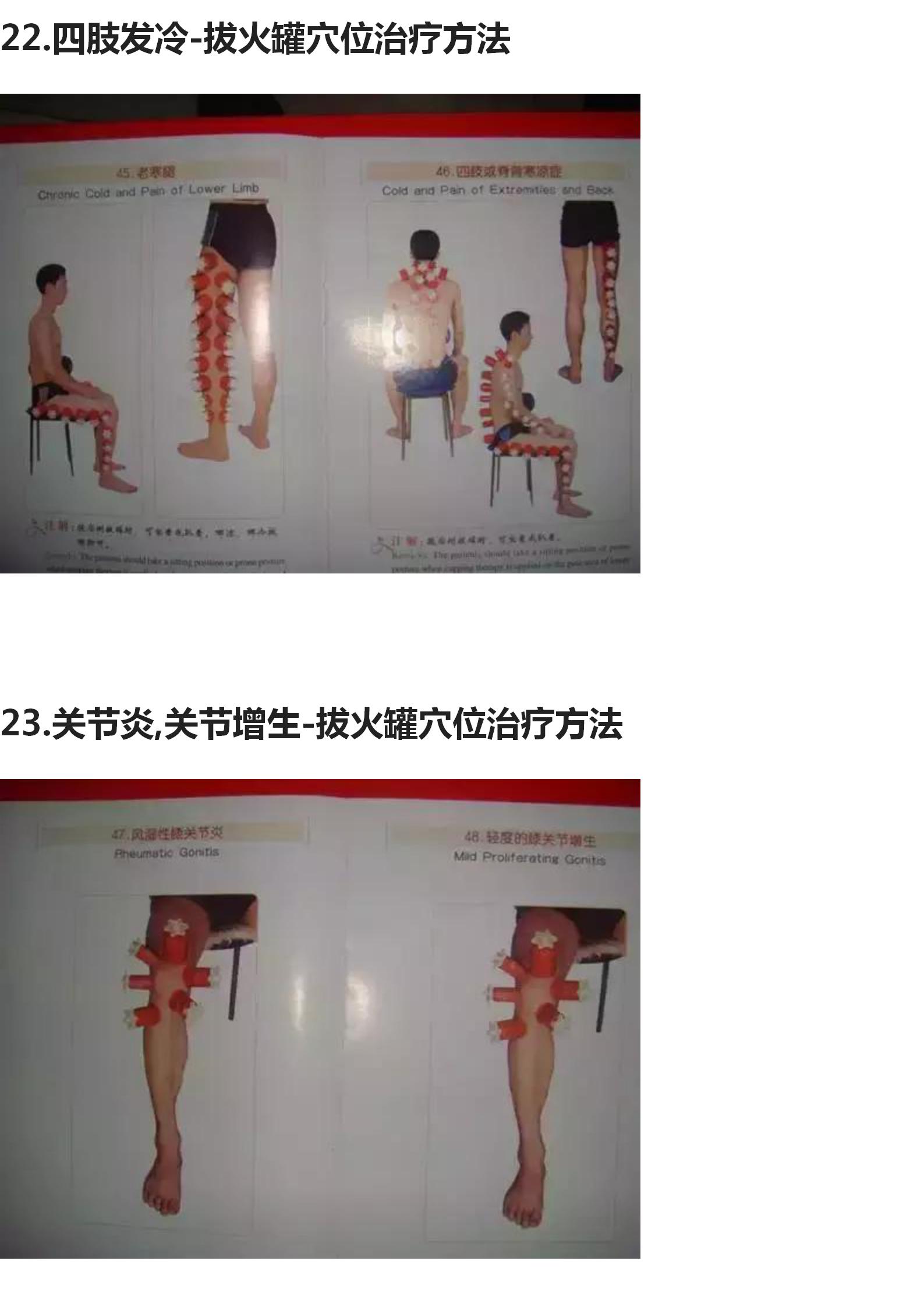 拔罐的手法和穴位图,中医拔罐穴位图片及作用