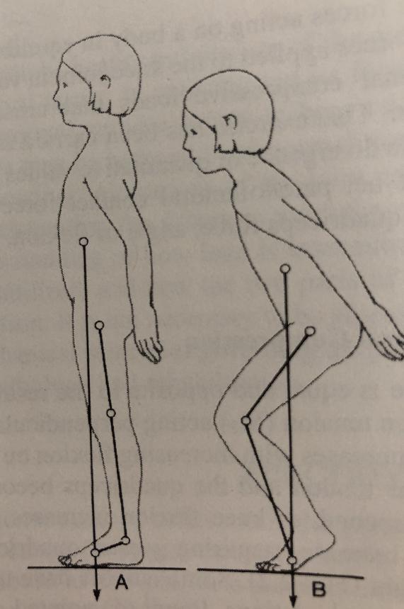 膝盖附近疼是髌骨软化症引起的吗,髌骨膝前疼痛综合症