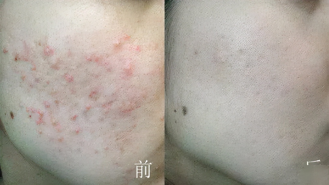 英国珀婷pertine除螨喷雾剂,瑞士珀婷pertine除螨喷雾剂