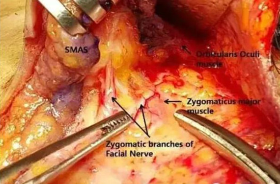抗衰老术,脸部抗衰老手术方法