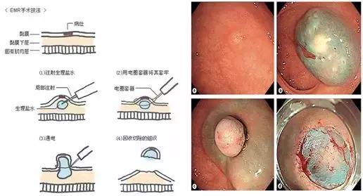 直肠神经内分泌肿瘤分级和治疗,直肠神经内分泌肿瘤到底是不是癌