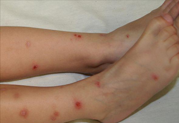 夏季虫咬皮炎怎么解决,夏季皮肤病攻略虫咬感染篇