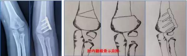 孩子胳膊向外弯怎么回事,小孩胳膊肘往内拐什么原因