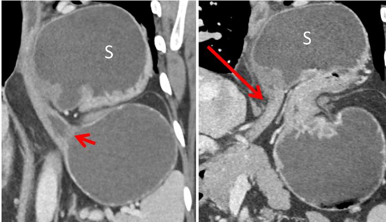 腹部ct能看出来胃的毛病吗,如果胃有问题腹部ct看得出来吗
