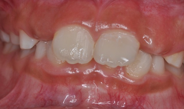 牙拔掉后扔掉还是留着,牙折断还能接回去吗