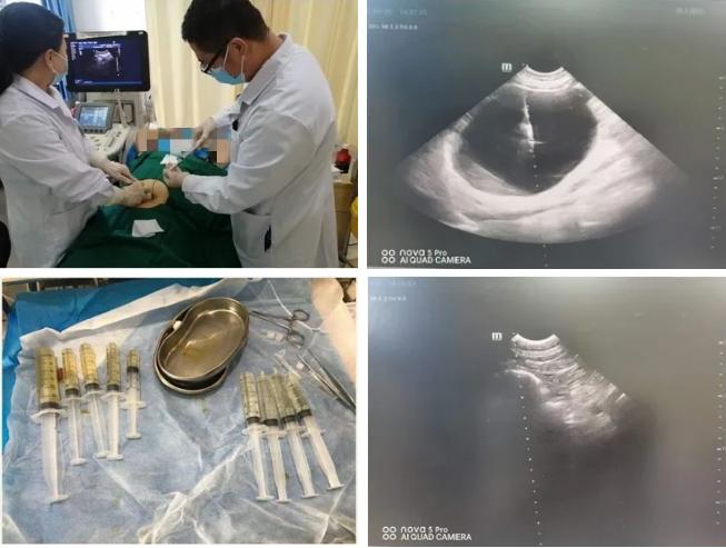 肝囊肿超声引导下硬化治疗泉州,王府医院肝科