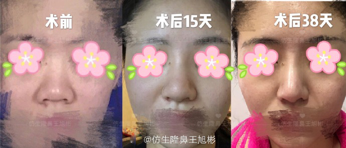 蒜头鼻可以只缩小鼻翼鼻头吗,怎么改善大鼻头宽鼻翼蒜头鼻