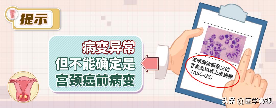 宫颈癌tct检查结果显示有轻度炎症,宫颈癌tct报告单可见挖空细胞