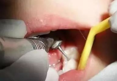 人人都说洗牙好,那补完牙可以洗牙吗?