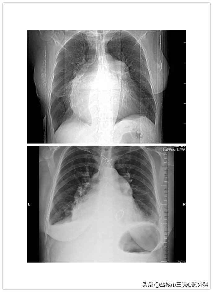 26载病程两次“生命相托”学科创新再把“牛心”修复
