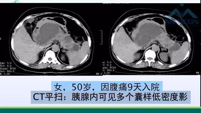 急性胰腺炎的护理措施,急性胰腺炎影像与临床